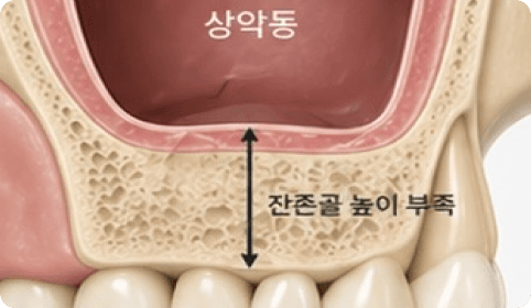 상악동 거상술 전