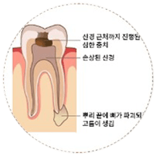 충치/염증 확인
