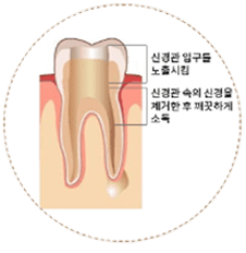 충치/염증제거