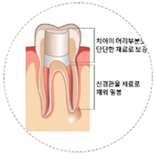 치아 내부 충전