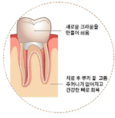 크라운 수복
